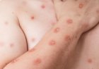 Ceará registra primeiro caso de mpox do ano; aponta monitoramento do Ministério da Saúde