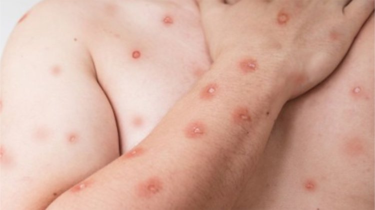 Ceará registra primeiro caso de mpox do ano; aponta monitoramento do Ministério da Saúde